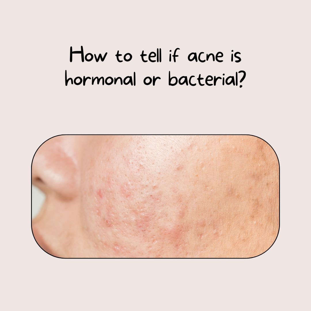 How to tell if acne is hormonal or bacterial?