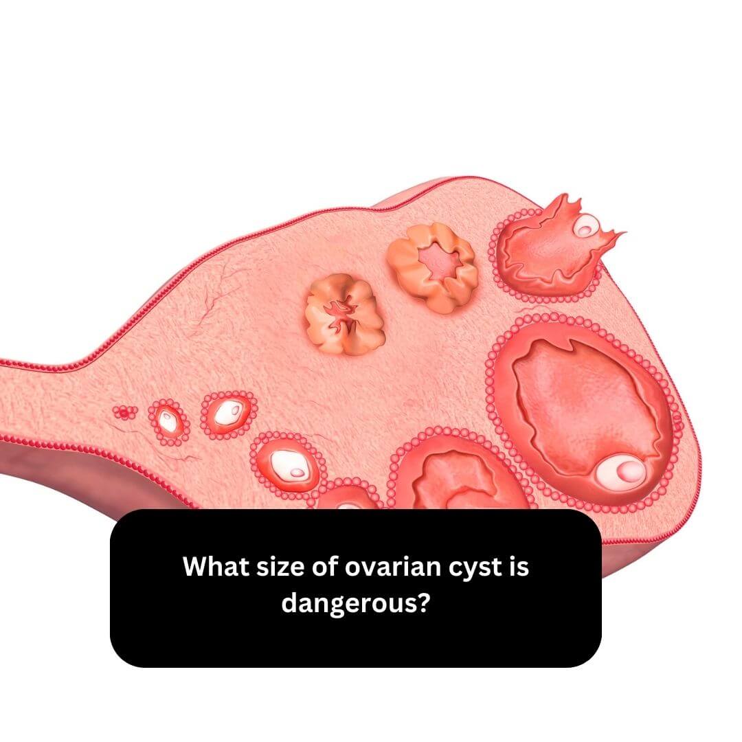What size of ovarian cyst is dangerous?